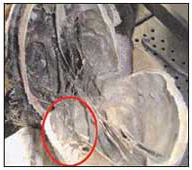 Larve rinvenute all'interno della cavità cranica durante un’autopsia.
